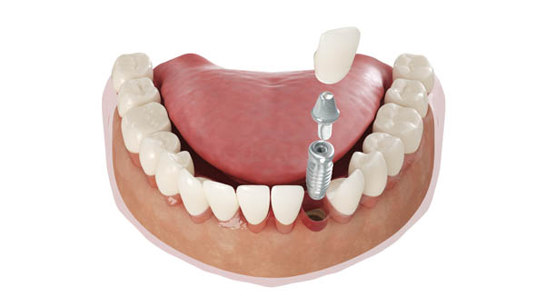 Dental Implant