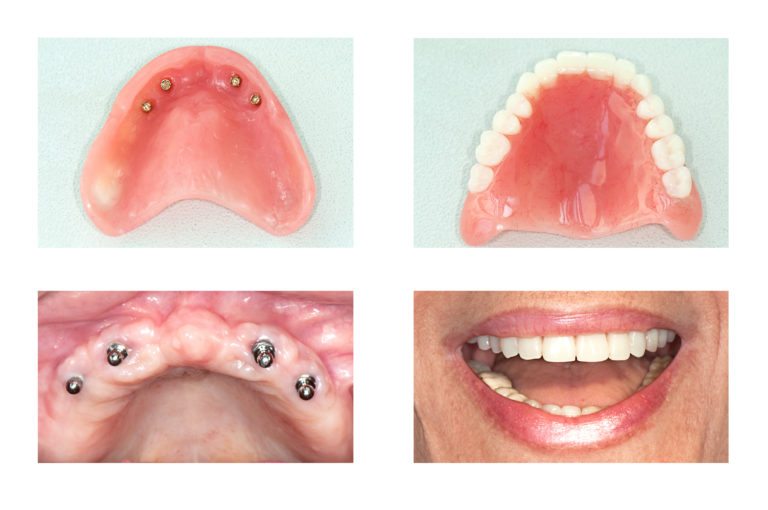 Denture with Implants