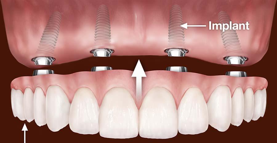 Denture with Implants